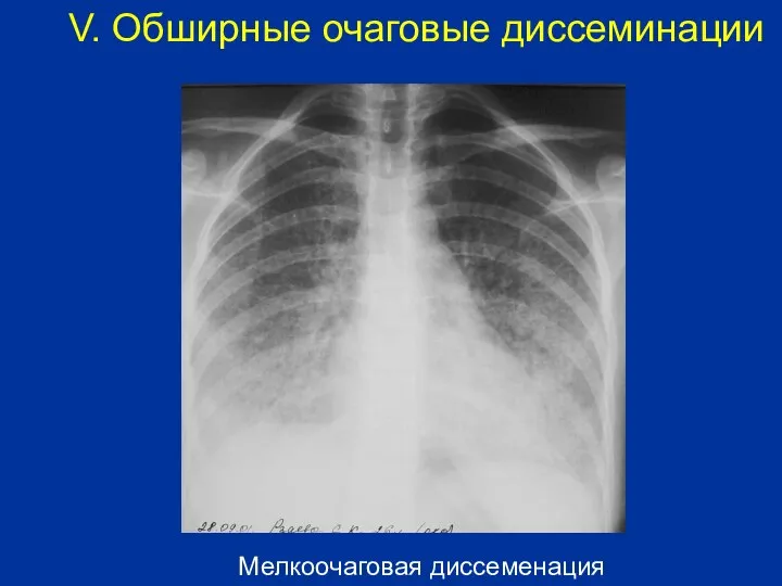 Мелкоочаговая диссеменация V. Обширные очаговые диссеминации