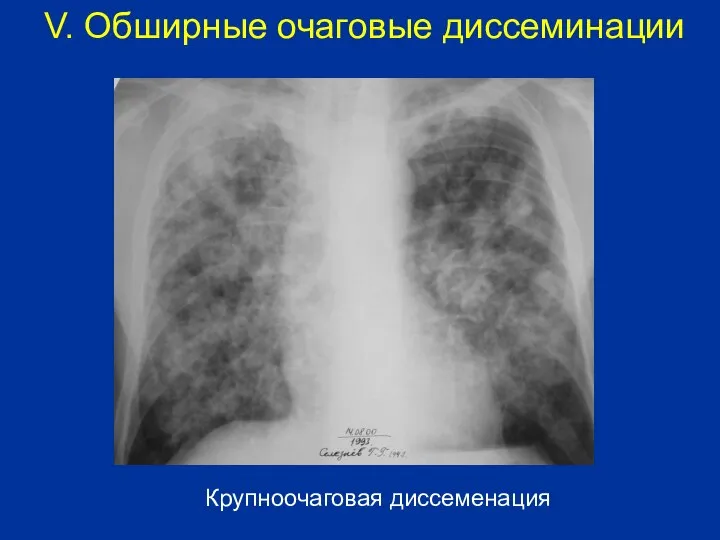 Крупноочаговая диссеменация V. Обширные очаговые диссеминации