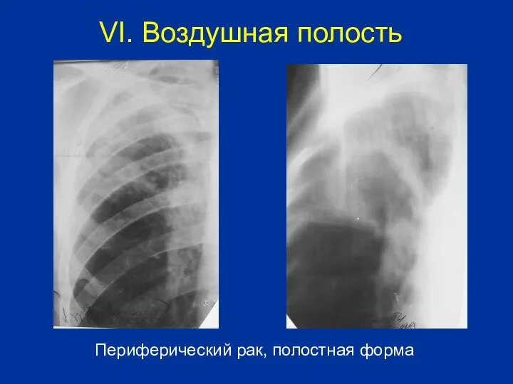 Периферический рак, полостная форма VI. Воздушная полость