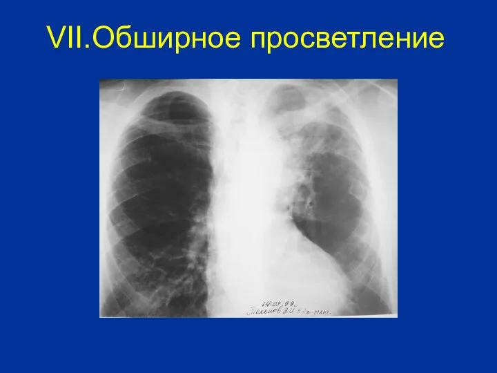 VII.Обширное просветление