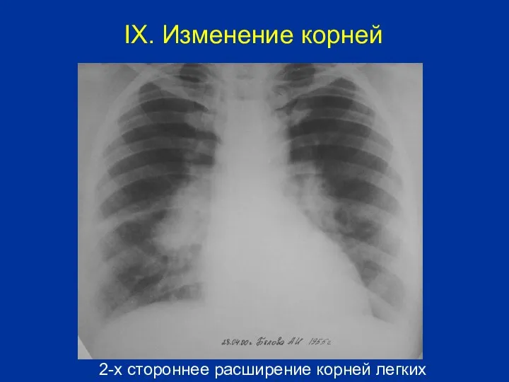 2-х стороннее расширение корней легких IX. Изменение корней