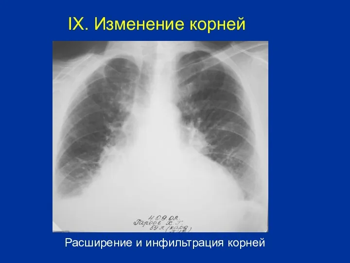 Расширение и инфильтрация корней IX. Изменение корней