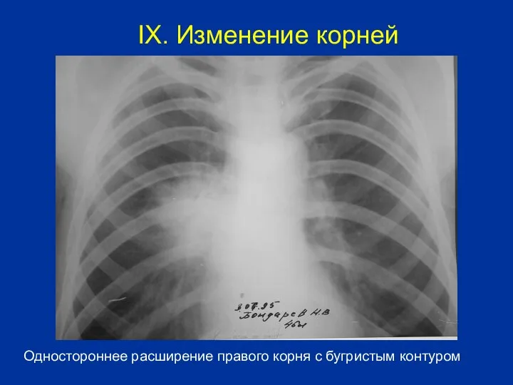 Одностороннее расширение правого корня с бугристым контуром IX. Изменение корней