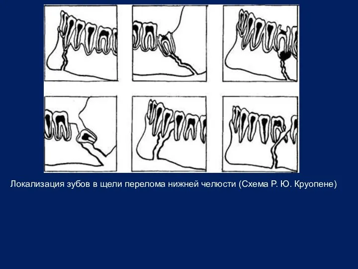 Локализация зубов в щели перелома нижней челюсти (Схема Р. Ю. Круопене)