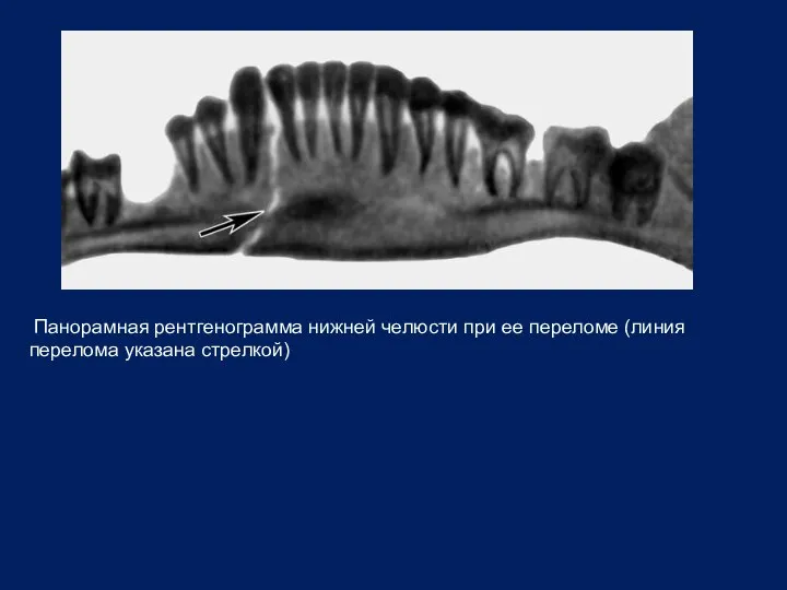 Панорамная рентгенограмма нижней челюсти при ее переломе (линия перелома указана стрелкой)