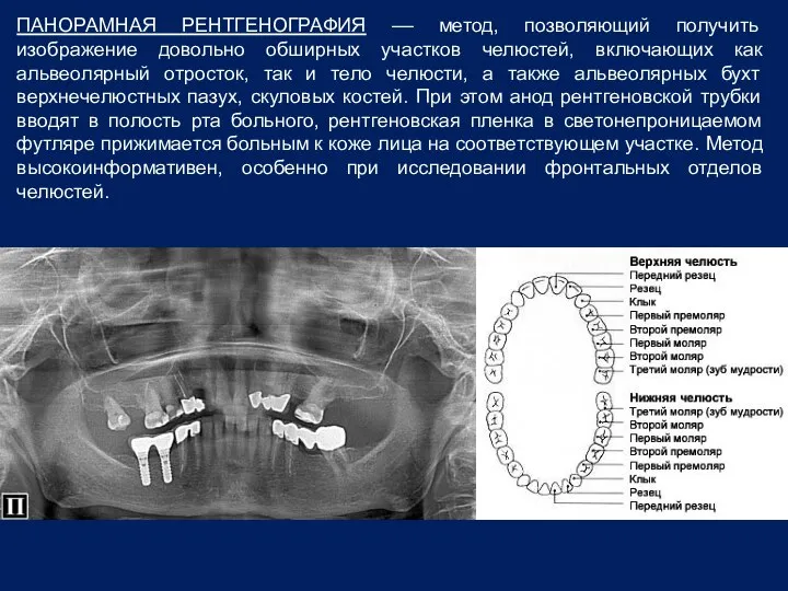 ПАНОРАМНАЯ РЕНТГЕНОГРАФИЯ –– метод, позволяющий получить изображение довольно обширных участков челюстей,