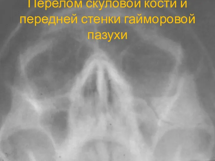 Перелом скуловой кости и передней стенки гайморовой пазухи