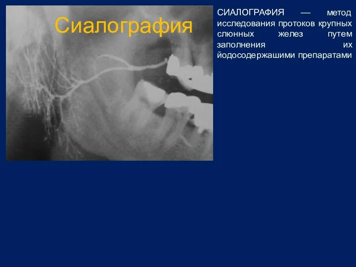 Сиалография СИАЛОГРАФИЯ –– метод исследования протоков крупных слюнных желез путем заполнения их йодосодержашими препаратами