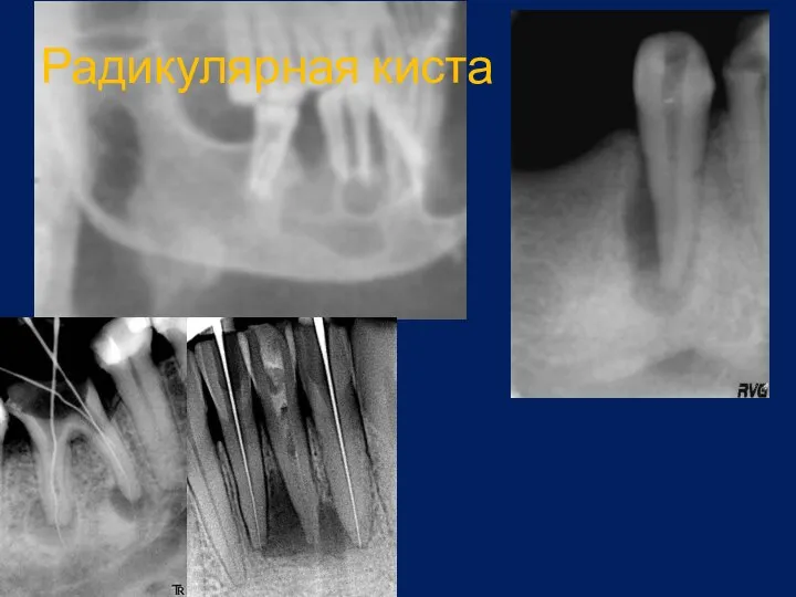 Радикулярная киста