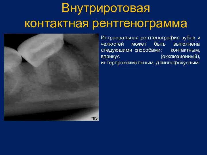 Внутриротовая контактная рентгенограмма Интраоральная рентгенография зубов и челюстей может быть выполнена