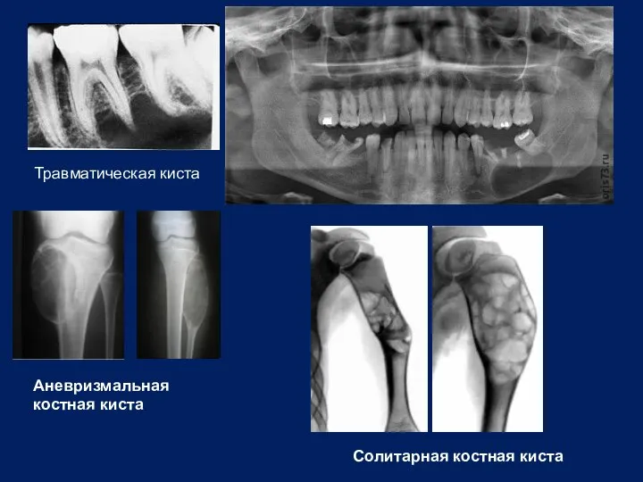 Травматическая киста Аневризмальная костная киста Солитарная костная киста