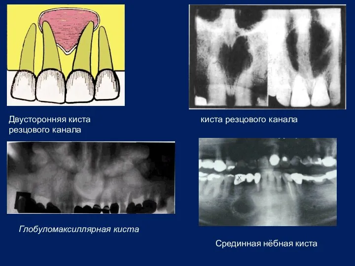 Двусторонняя киста резцового канала киста резцового канала Глобуломаксиллярная киста Срединная нёбная киста