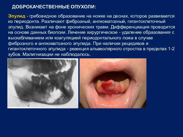 Эпулид - грибовидное образование на ножке на деснах, которое развивается из