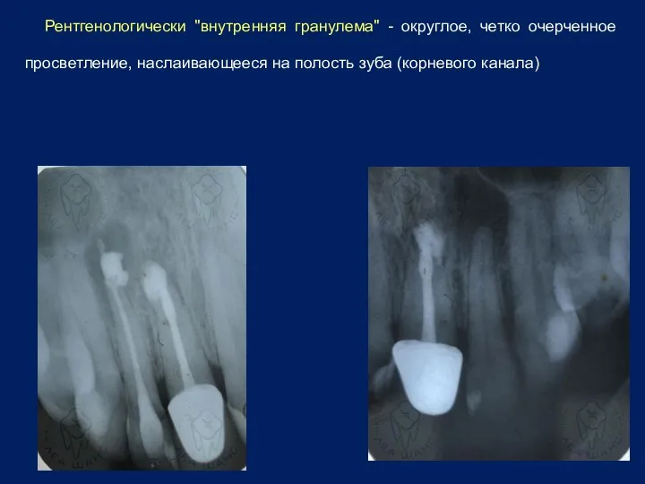 Рентгенологически "внутренняя гранулема" - округлое, четко очерченное просветление, наслаивающееся на полость зуба (корневого канала)