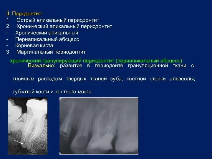 II. Пародонтит: 1. Острый апикальный периодонтит 2. Хронический апикальный периодонтит -