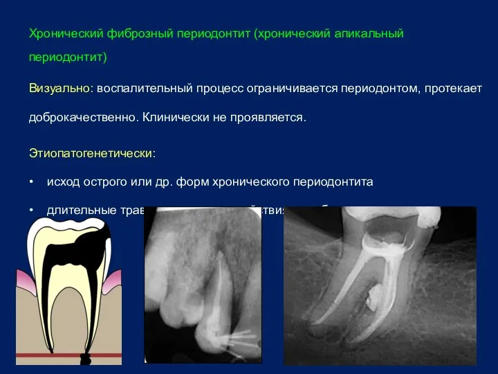 Хронический фиброзный периодонтит (хронический апикальный периодонтит) Визуально: воспалительный процесс ограничивается периодонтом,