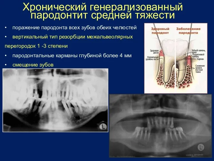 Хронический генерализованный пародонтит средней тяжести • поражение пародонта всех зубов обеих