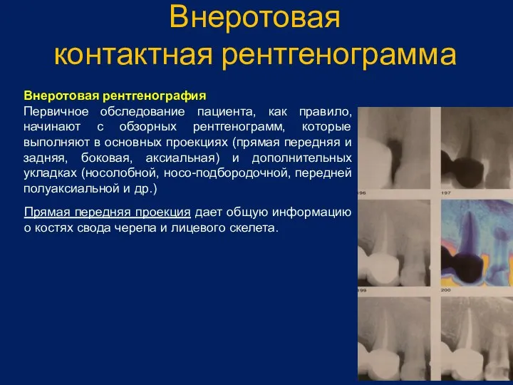 Внеротовая контактная рентгенограмма Внеротовая рентгенография Первичное обследование пациента, как правило, начинают