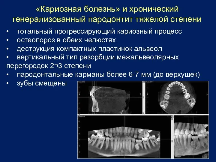 «Кариозная болезнь» и хронический генерализованный пародонтит тяжелой степени • тотальный прогрессирующий