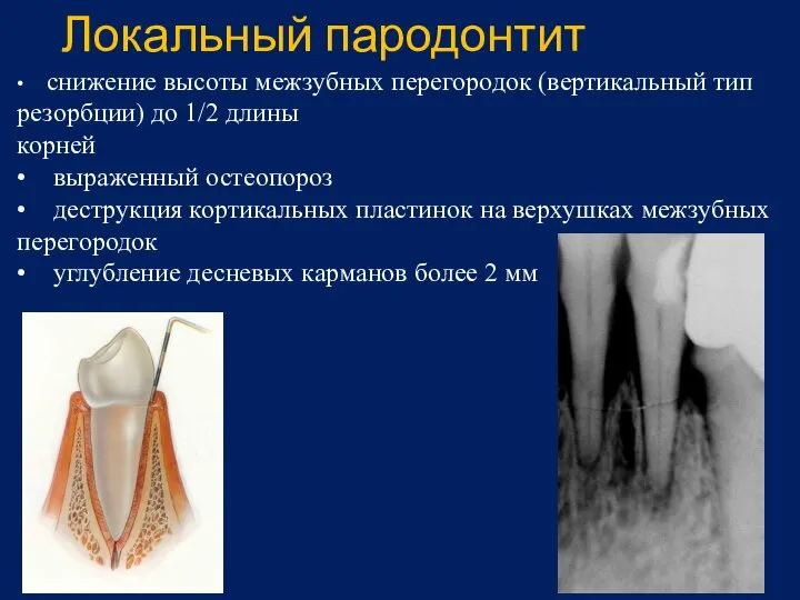 Локальный пародонтит • снижение высоты межзубных перегородок (вертикальный тип резорбции) до