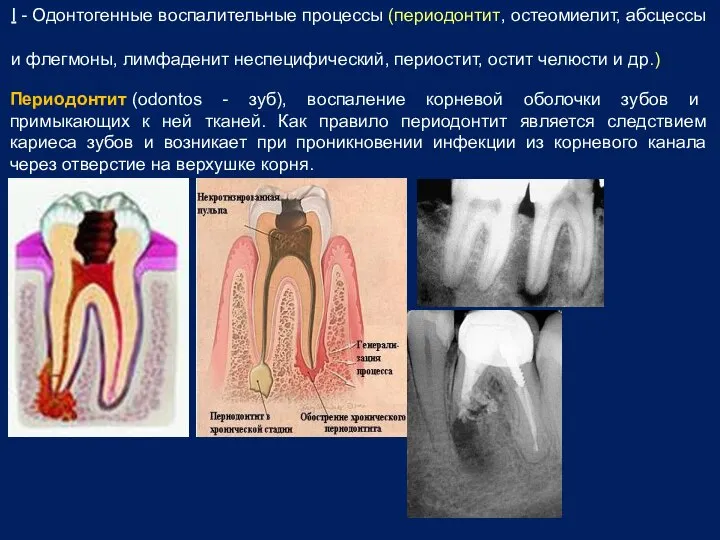 I - Одонтогенные воспалительные процессы (периодонтит, остеомиелит, абсцессы и флегмоны, лимфаденит