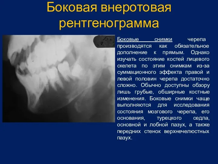 Боковая внеротовая рентгенограмма Боковые снимки черепа производятся как обязательное дополнение к