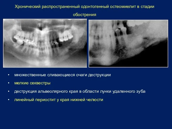 Хронический распространенный одонтогенный остеомиелит в стадии обострения • множественные сливающиеся очаги