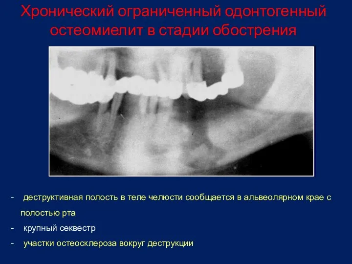 Хронический ограниченный одонтогенный остеомиелит в стадии обострения - деструктивная полость в