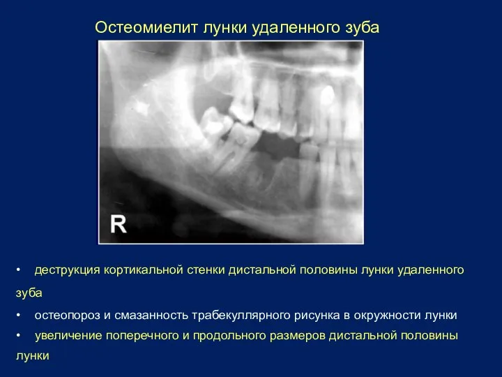 Остеомиелит лунки удаленного зуба • деструкция кортикальной стенки дистальной половины лунки