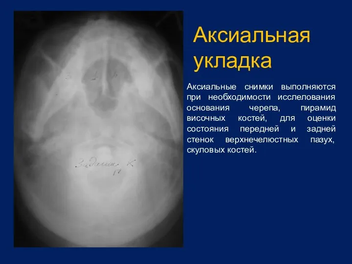 Аксиальная укладка Аксиальные снимки выполняются при необходимости исслелования основания черепа, пирамид