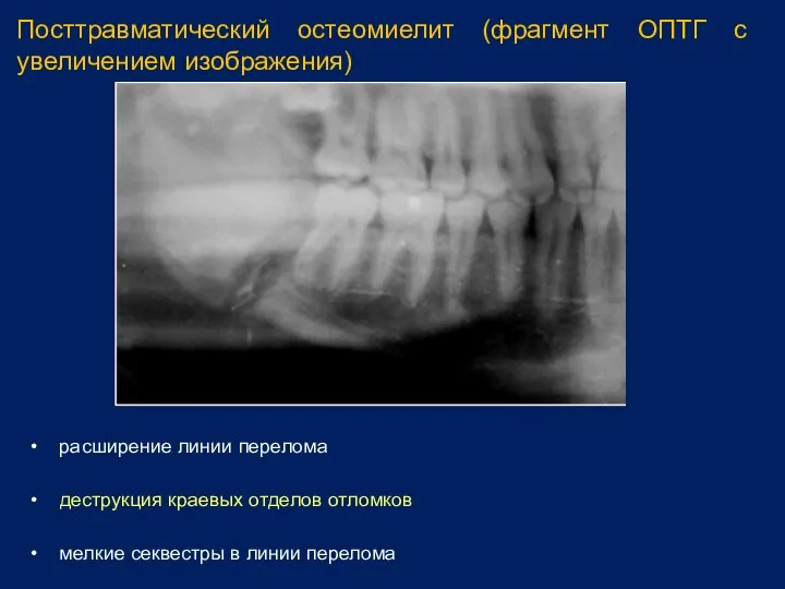 Посттравматический остеомиелит (фрагмент ОПТГ с увеличением изображения) • расширение линии перелома