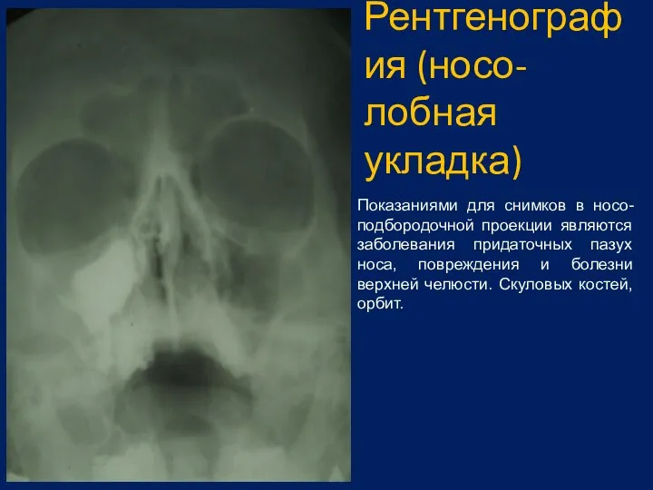 Рентгенография (носо-лобная укладка) Показаниями для снимков в носо-подбородочной проекции являются заболевания