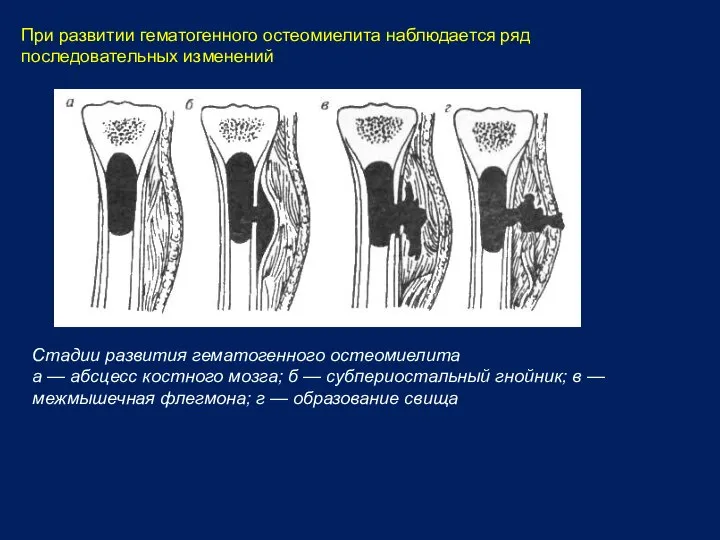 При развитии гематогенного остеомиелита наблюдается ряд последовательных изменений Стадии развития гематогенного