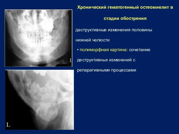 Хронический гематогенный остеомиелит в стадии обострения деструктивные изменения половины нижней челюсти