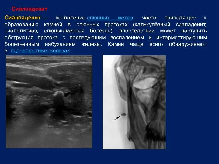 Сиалоаденит — воспаление слюнных желез, часто приводящее к образованию камней в