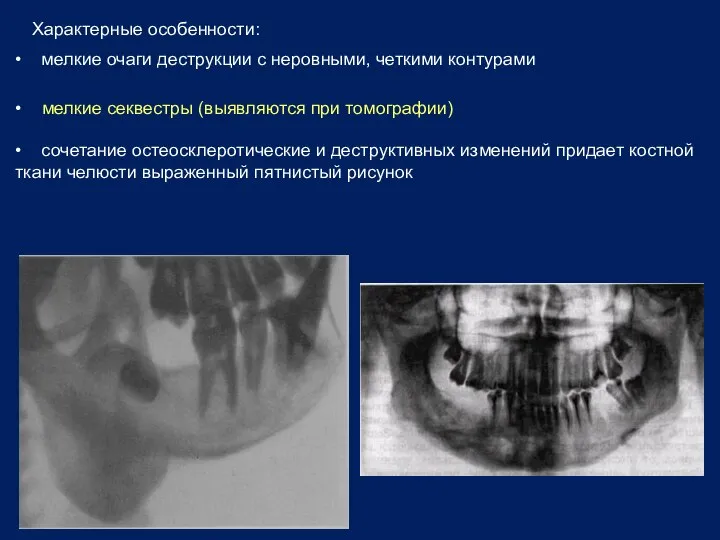 Характерные особенности: • мелкие очаги деструкции с неровными, четкими контурами •