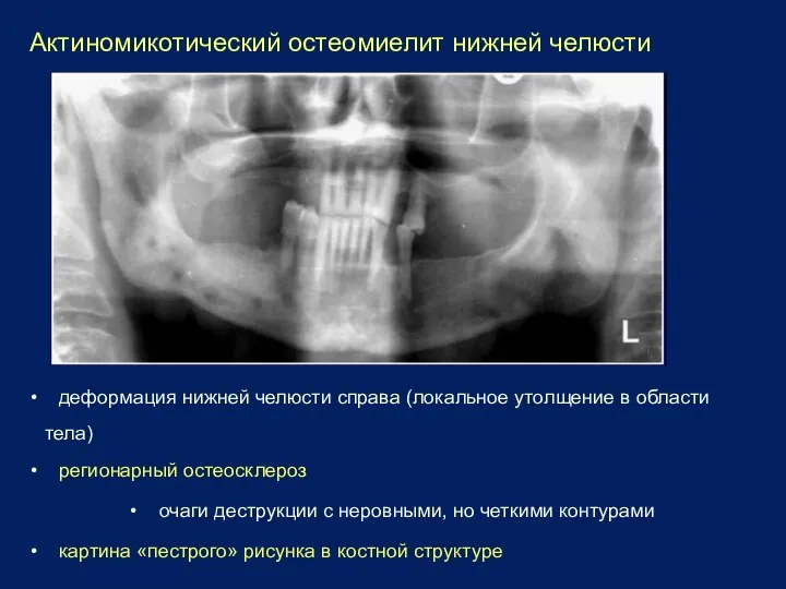 Актиномикотический остеомиелит нижней челюсти • деформация нижней челюсти справа (локальное утолщение