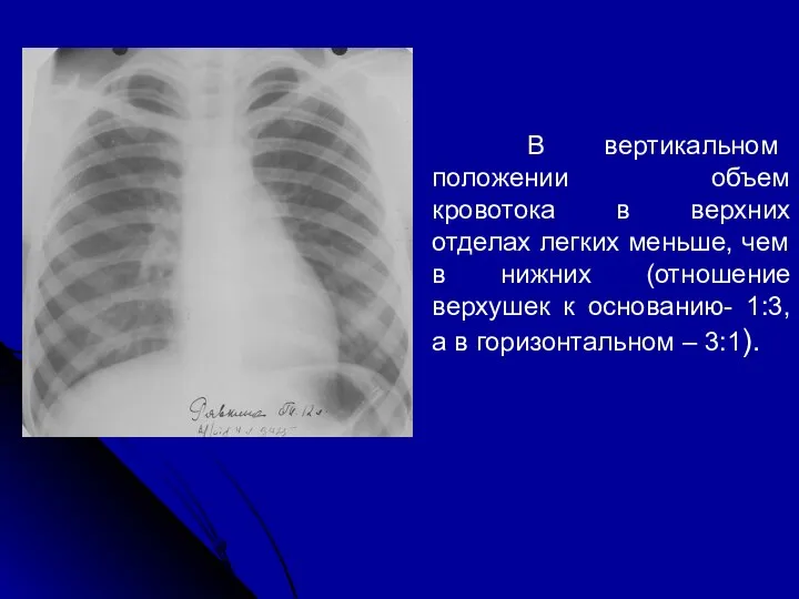 В вертикальном положении объем кровотока в верхних отделах легких меньше, чем