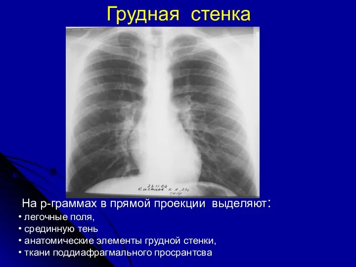 На р-граммах в прямой проекции выделяют: легочные поля, срединную тень анатомические