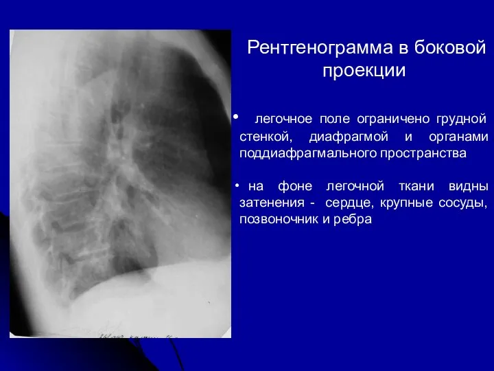 Рентгенограмма в боковой проекции легочное поле ограничено грудной стенкой, диафрагмой и