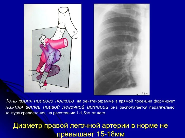 Тень корня правого легкого на рентгенограмме в прямой проекции формирует нижняя