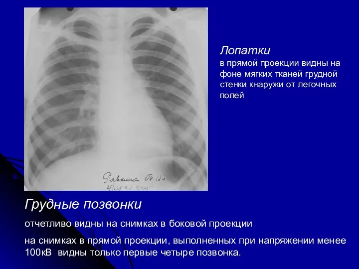 Грудные позвонки отчетливо видны на снимках в боковой проекции на снимках