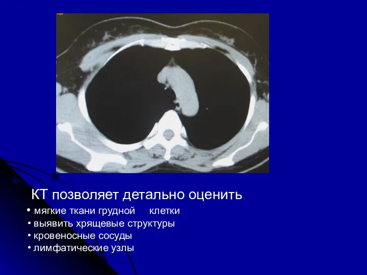 КТ позволяет детально оценить мягкие ткани грудной клетки выявить хрящевые структуры кровеносные сосуды лимфатические узлы