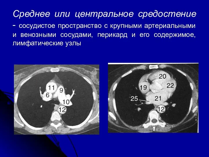Среднее или центральное средостение - сосудистое пространство с крупными артериальными и