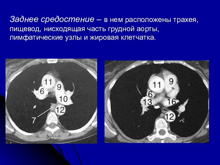 Заднее средостение – в нем расположены трахея, пищевод, нисходящая часть грудной