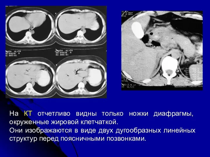 На КТ отчетливо видны только ножки диафрагмы, окруженные жировой клетчаткой. Они