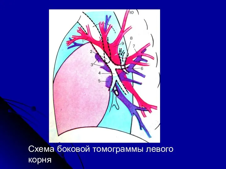 Схема боковой томограммы левого корня