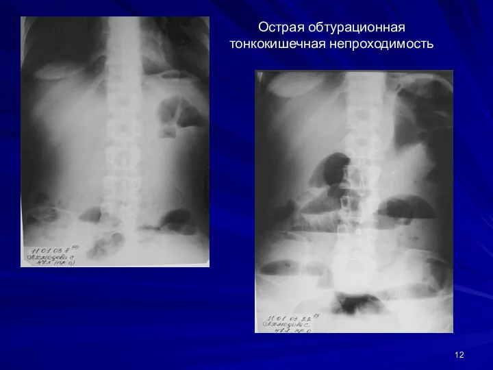 Острая обтурационная тонкокишечная непроходимость