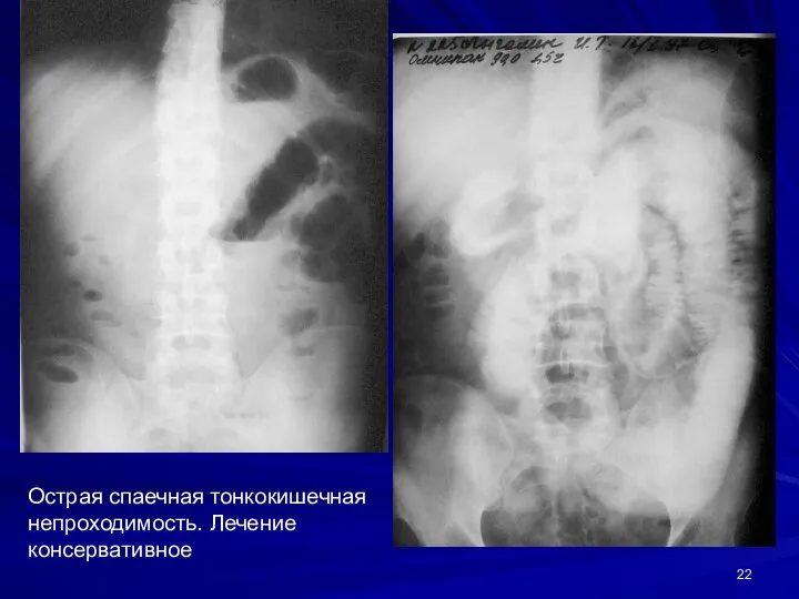 Острая спаечная тонкокишечная непроходимость. Лечение консервативное