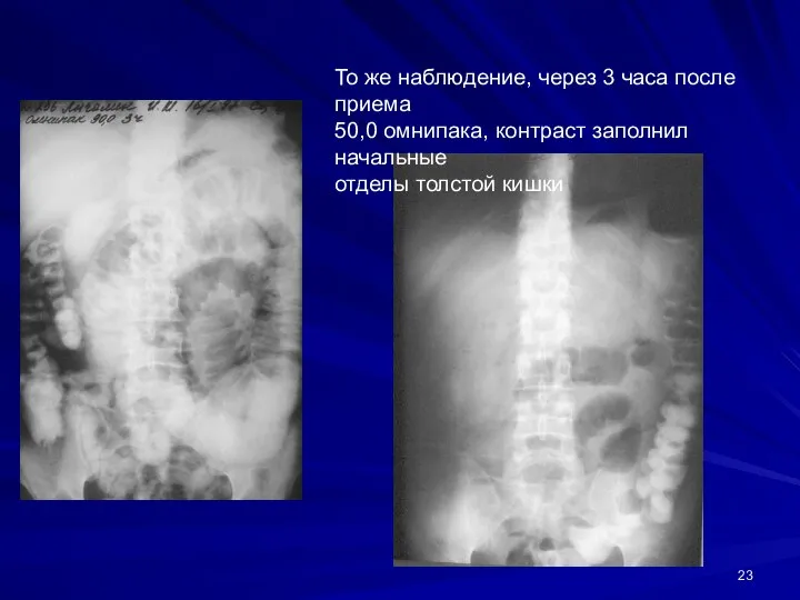 То же наблюдение, через 3 часа после приема 50,0 омнипака, контраст заполнил начальные отделы толстой кишки